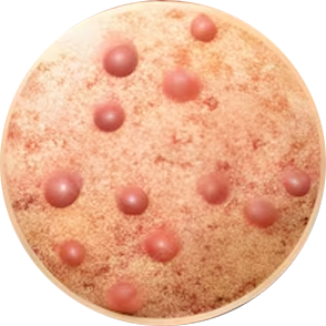 Psoriasis Recovery