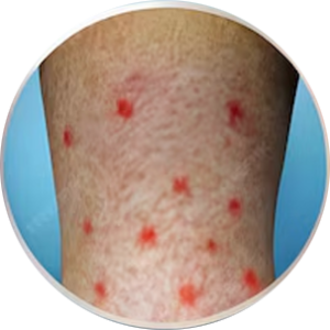 Psoriasis Freedom